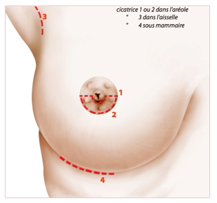 Chirurgie des seins Tunisie