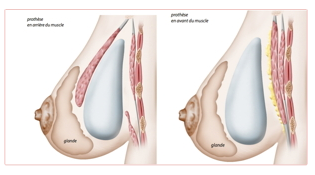 Chirurgie des seins Tunisie